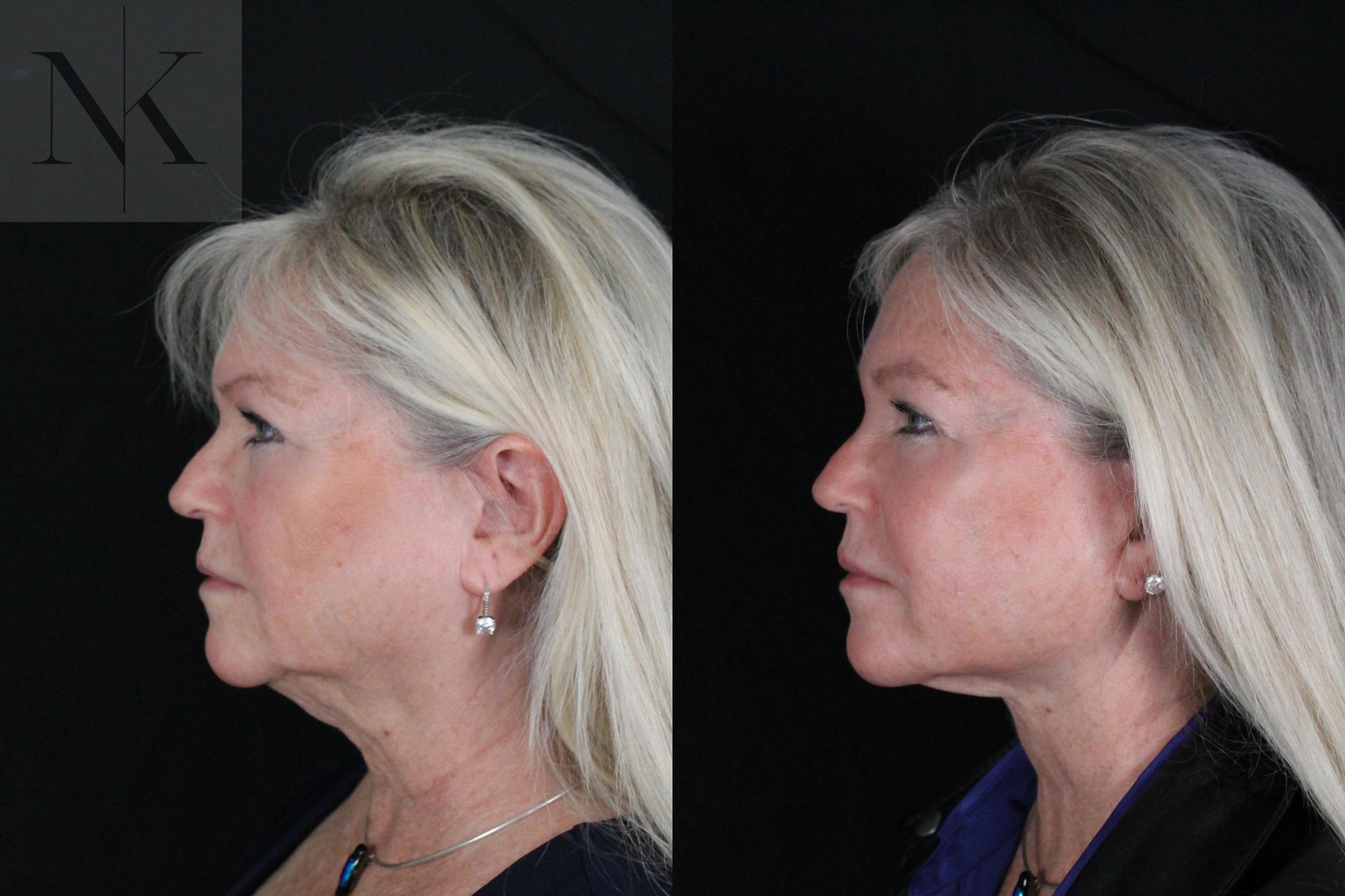 Before & After Deep Plane Facelift Case 196 Left Side View in Wethersfield, Hartford, Nebraska