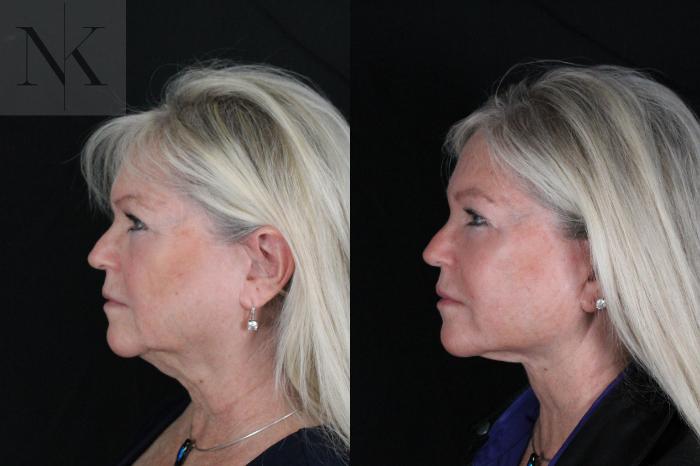 Before & After Deep Plane Facelift Case 196 Left Side View in Wethersfield, Hartford, Nebraska