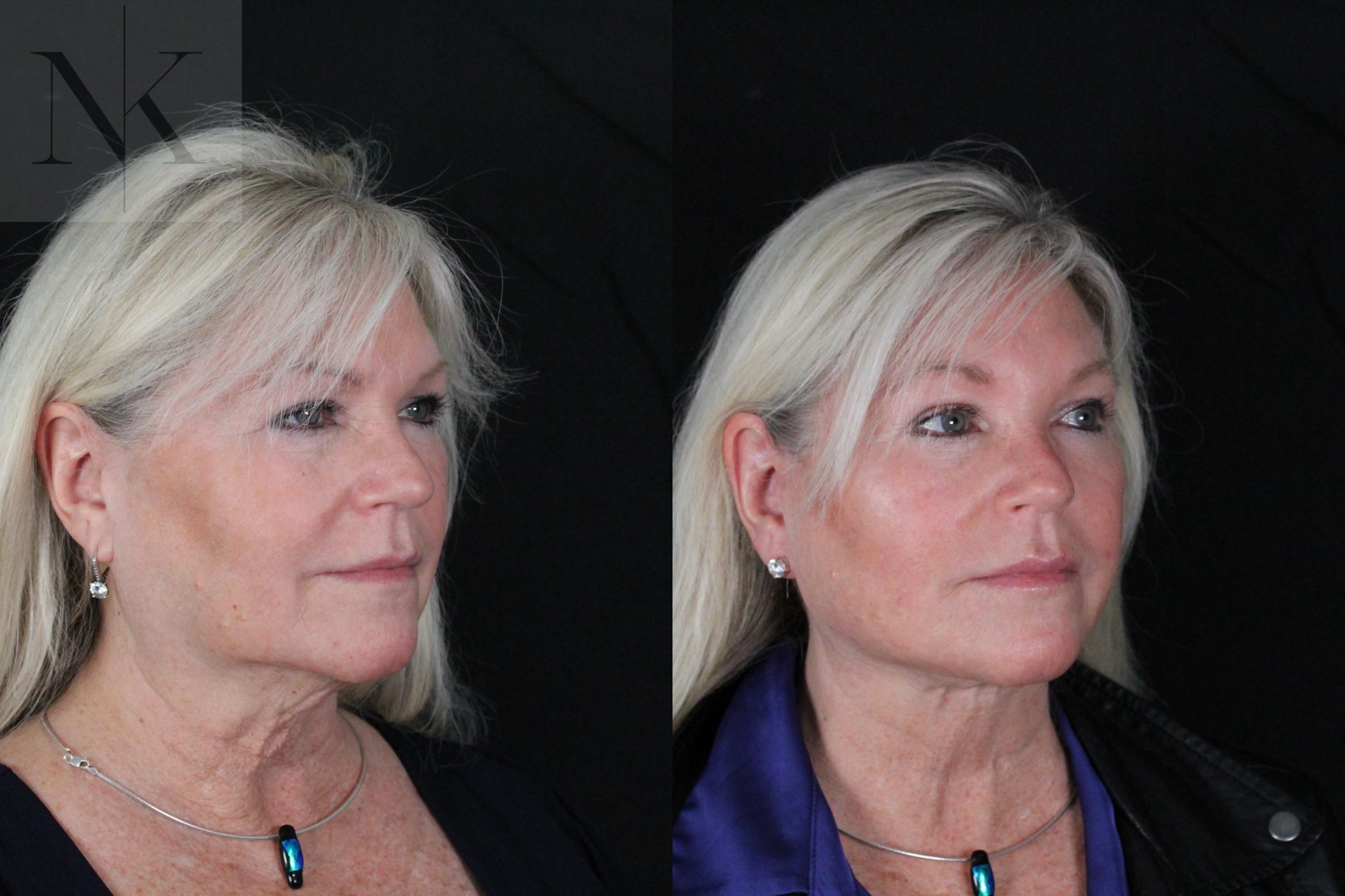 Before & After Deep Plane Facelift Case 196 Right Oblique View in Wethersfield, Hartford, Nebraska