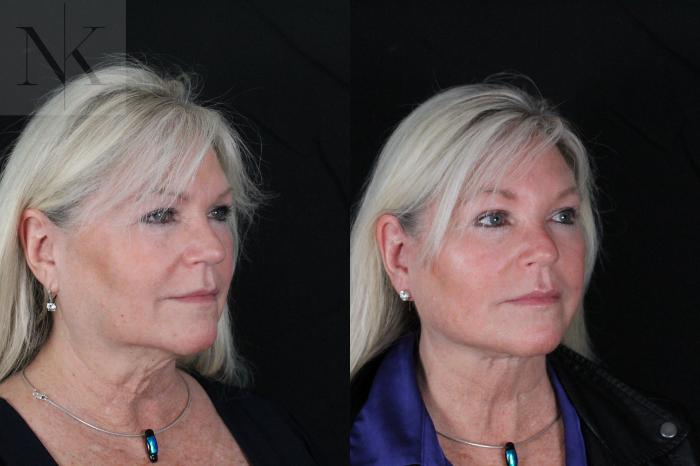 Before & After Deep Plane Facelift Case 196 Right Oblique View in Wethersfield, Hartford, Nebraska