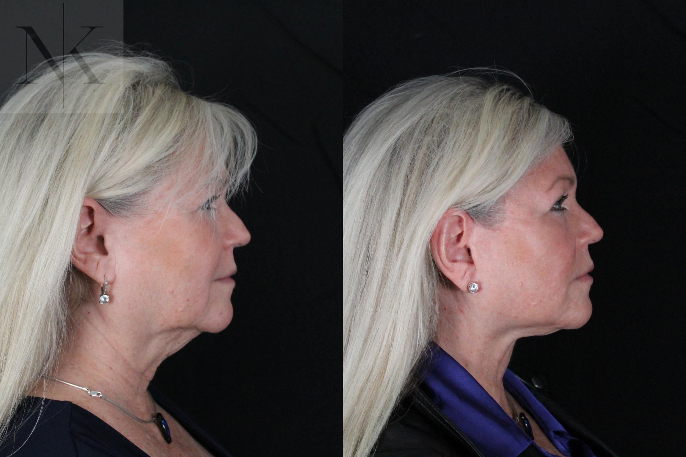 Before & After Deep Plane Facelift Case 196 Right Side View in Wethersfield, Hartford, Nebraska