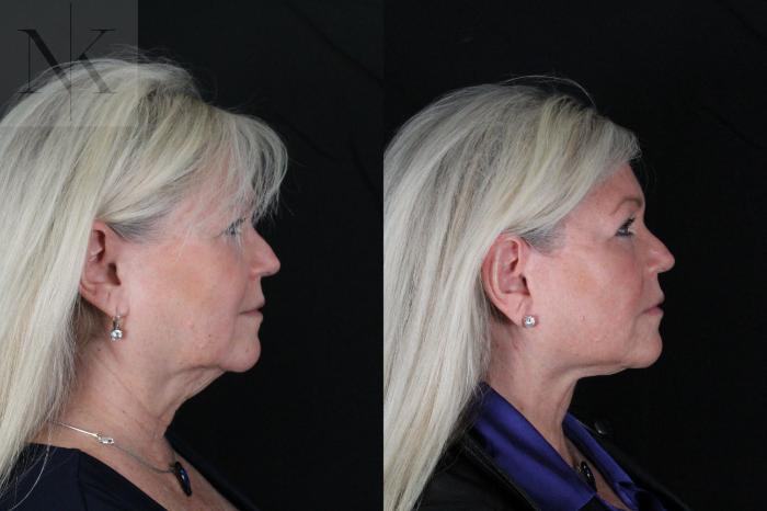 Before & After Deep Plane Facelift Case 196 Right Side View in Wethersfield, Hartford, Nebraska
