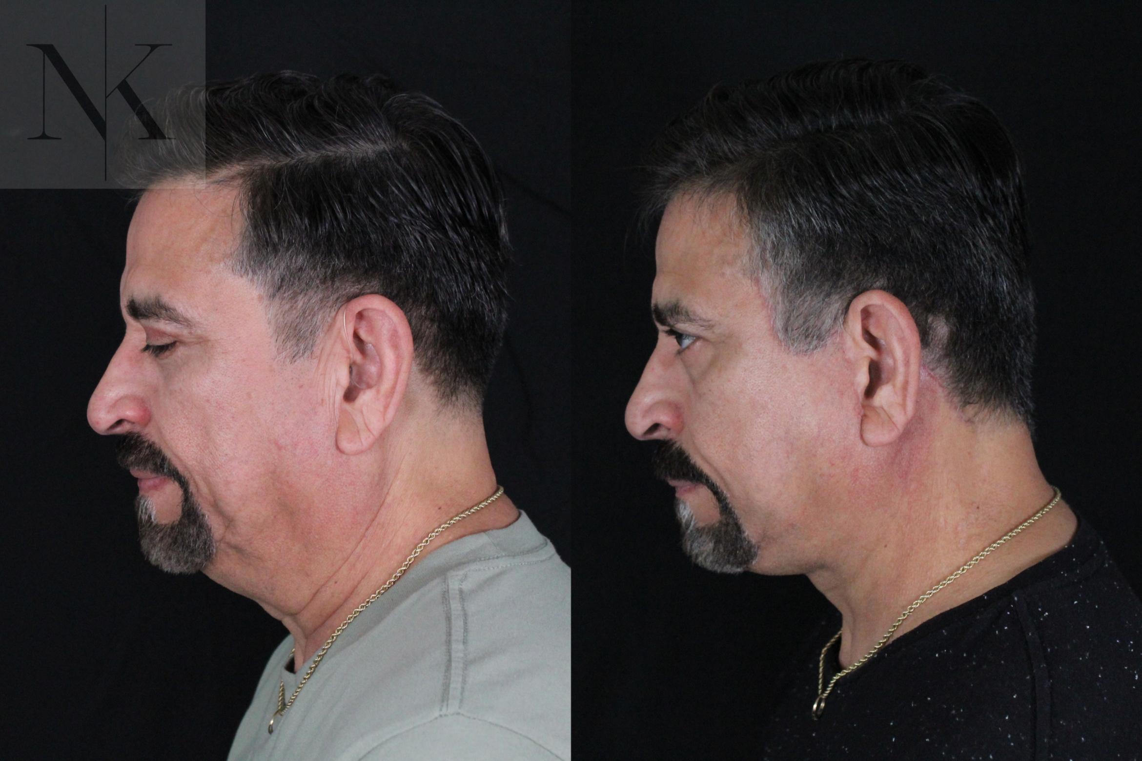 Before & After Deep Plane Facelift Case 197 Down Left View in Wethersfield, Hartford, Nebraska