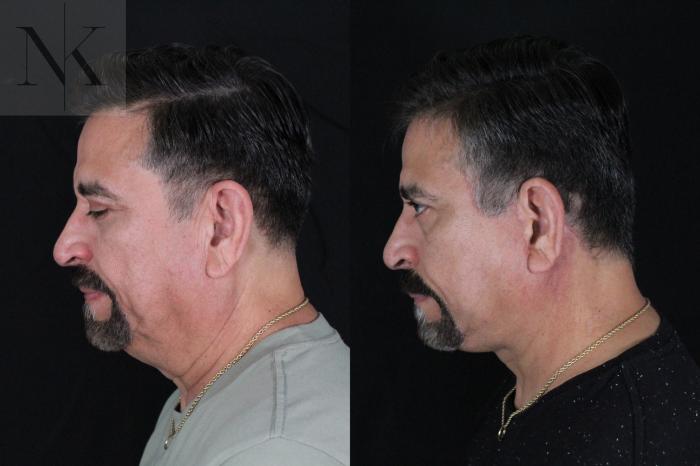 Before & After Deep Plane Facelift Case 197 Down Left View in Wethersfield, Hartford, Nebraska