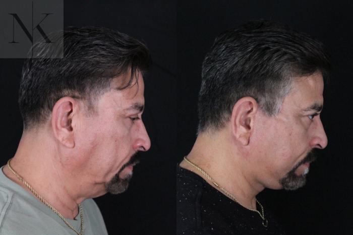 Before & After Deep Plane Facelift Case 197 Down Right View in Wethersfield, Hartford, Nebraska
