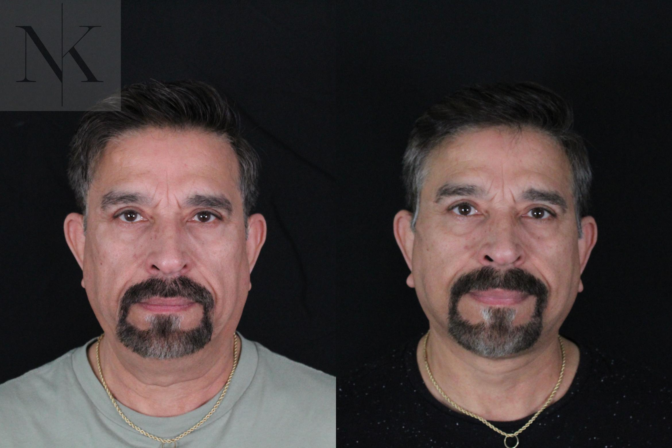 Before & After Deep Plane Facelift Case 197 Front View in Wethersfield, Hartford, Nebraska