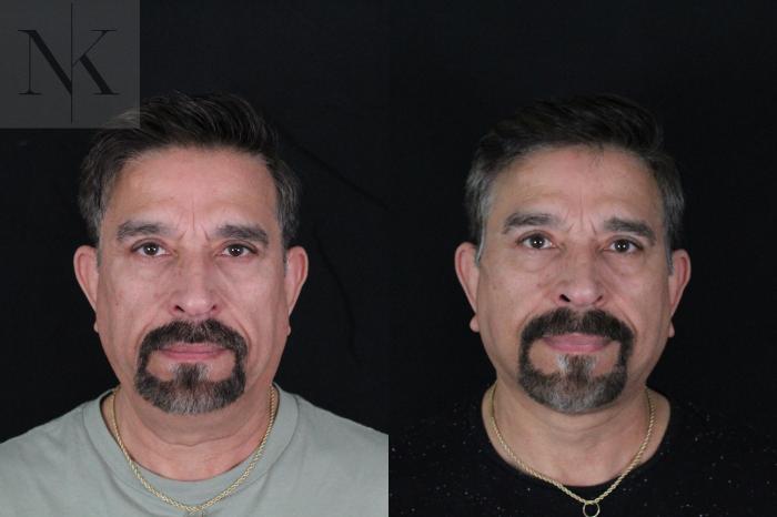 Before & After Deep Plane Facelift Case 197 Front View in Wethersfield, Hartford, Nebraska