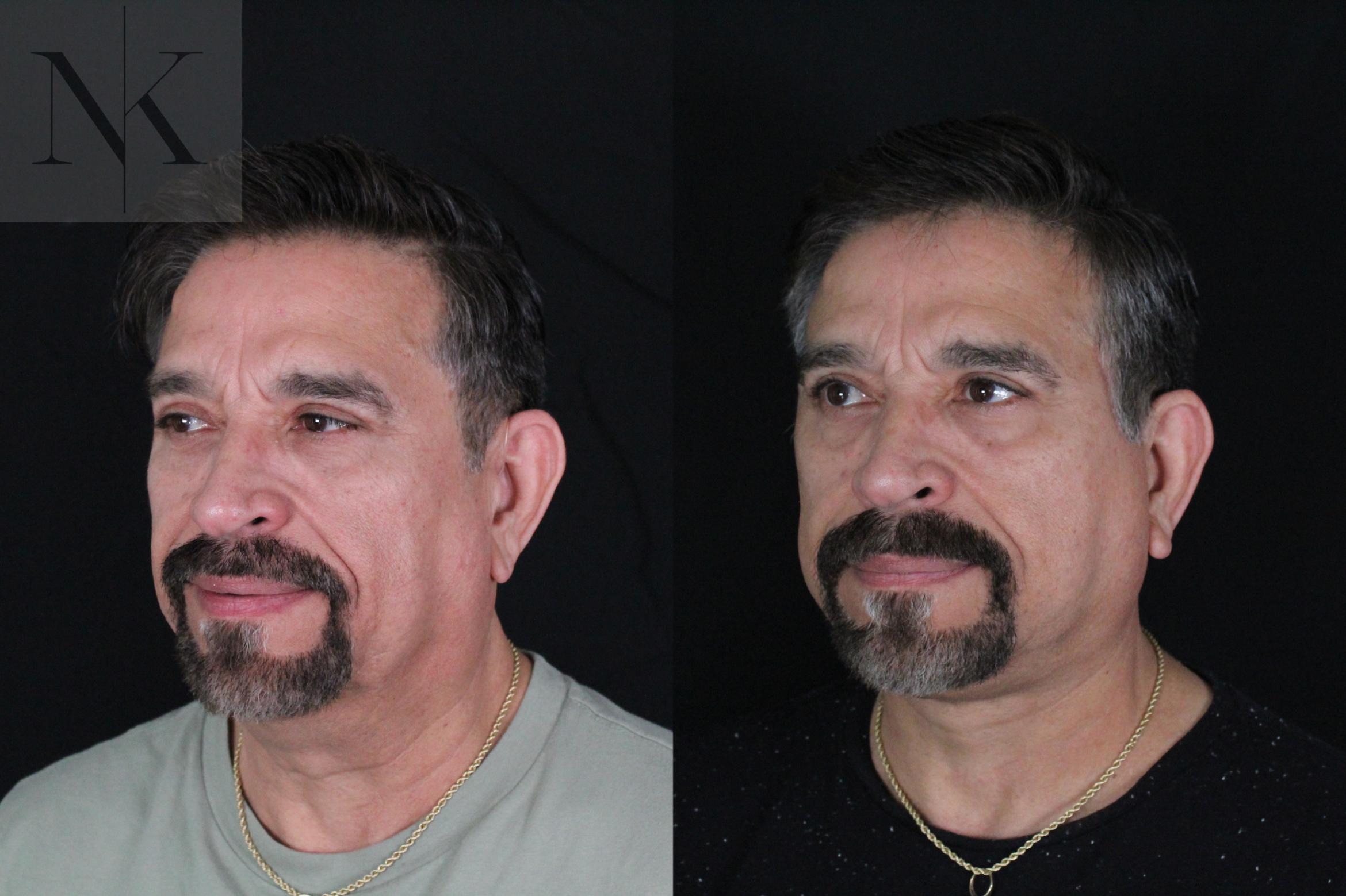 Before & After Deep Plane Facelift Case 197 Left Oblique View in Wethersfield, Hartford, Nebraska