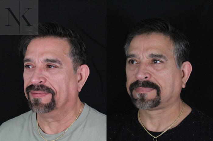 Before & After Deep Plane Facelift Case 197 Left Oblique View in Wethersfield, Hartford, Nebraska