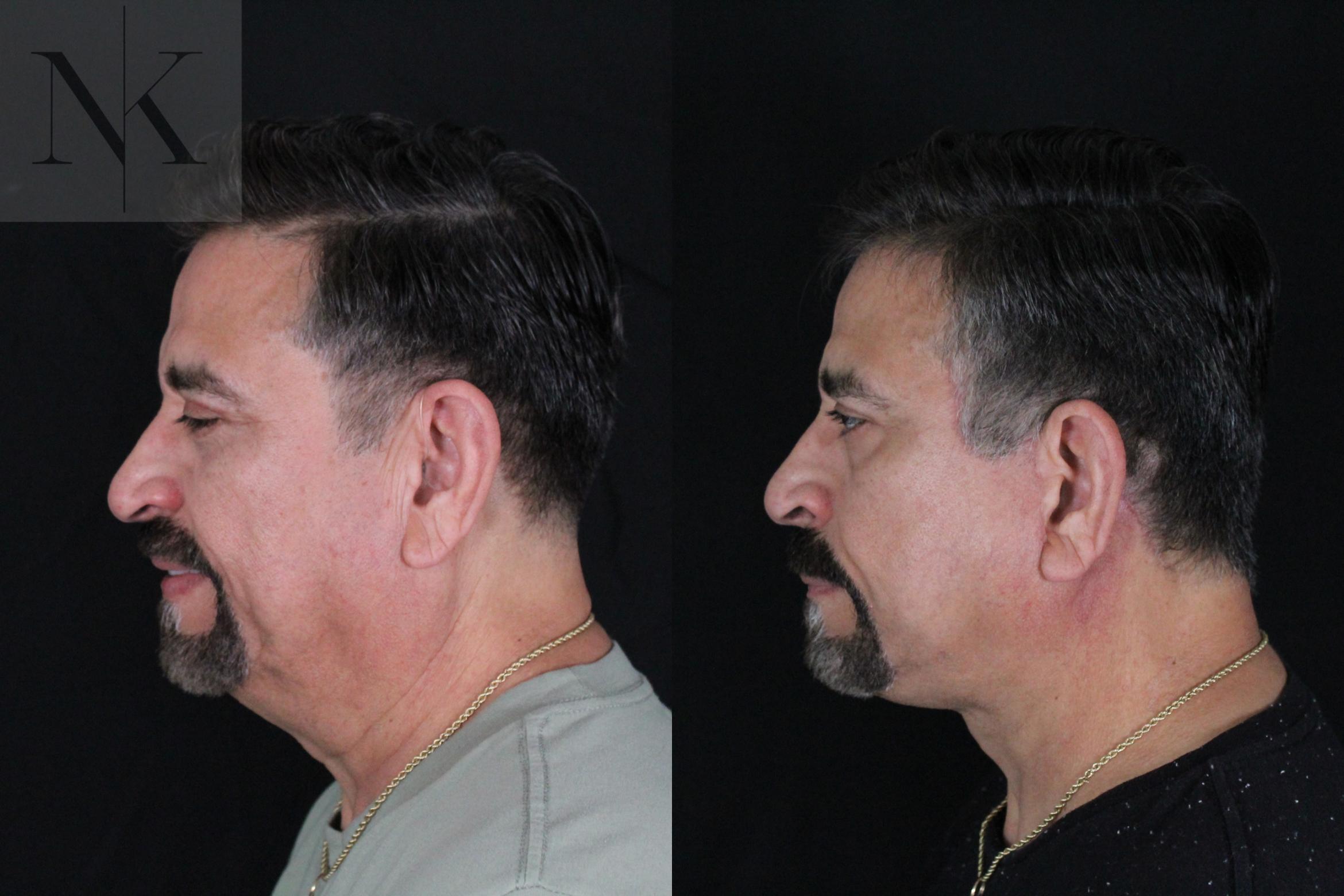 Before & After Deep Plane Facelift Case 197 Left Side View in Wethersfield, Hartford, Nebraska