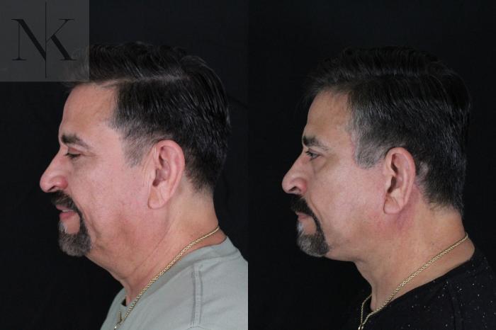 Before & After Deep Plane Facelift Case 197 Left Side View in Wethersfield, Hartford, Nebraska