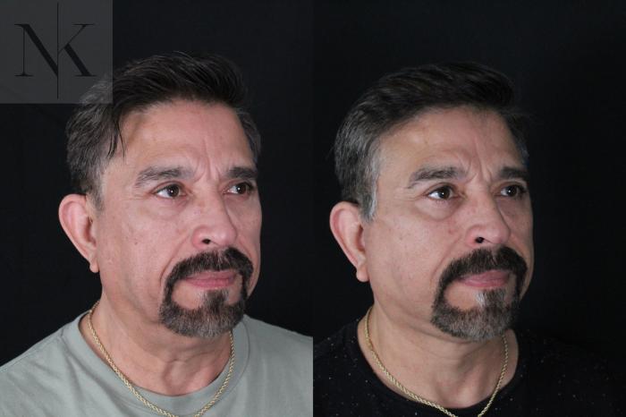 Before & After Deep Plane Facelift Case 197 Right Oblique View in Wethersfield, Hartford, Nebraska