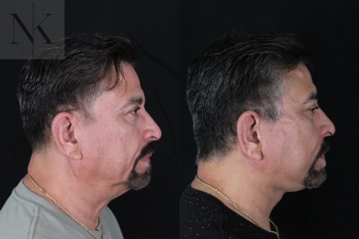 Before & After Deep Plane Facelift Case 197 Right Side View in Wethersfield, Hartford, Nebraska