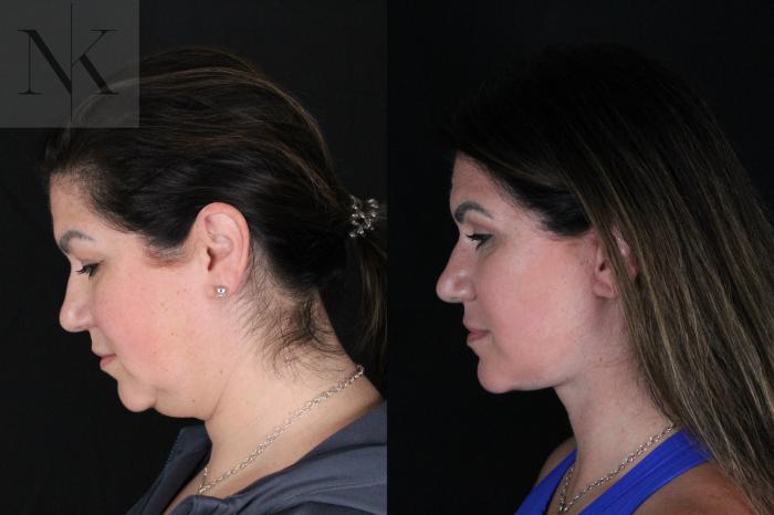 Before & After Deep Plane Facelift Case 199 Down Left View in Wethersfield, Hartford, Nebraska