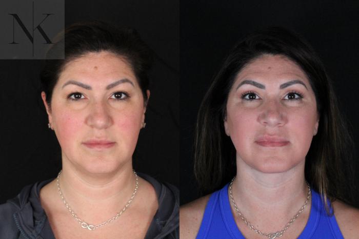 Before & After Deep Plane Facelift Case 199 Front View in Wethersfield, Hartford, Nebraska