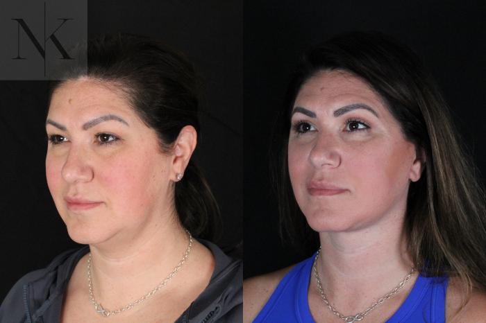 Before & After Deep Plane Facelift Case 199 Left Oblique View in Wethersfield, Hartford, Nebraska