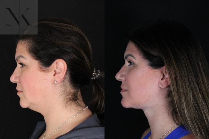 Before & After Deep Plane Facelift Case 199 Left Side View in Wethersfield, Hartford, Nebraska