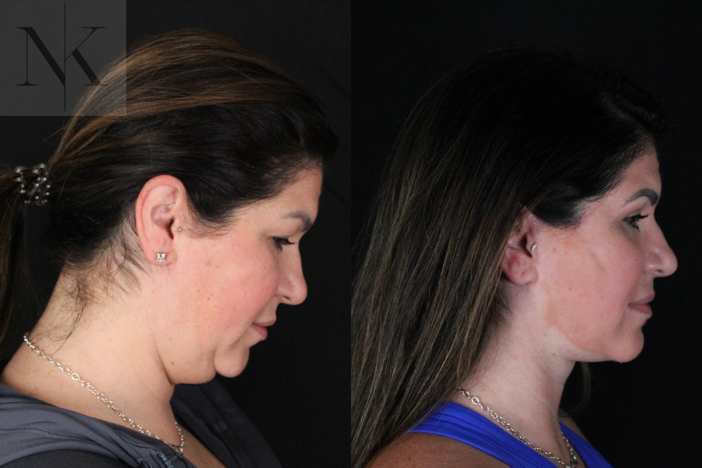 Before & After Deep Plane Facelift Case 199 Right Down View in Wethersfield, Hartford, Nebraska