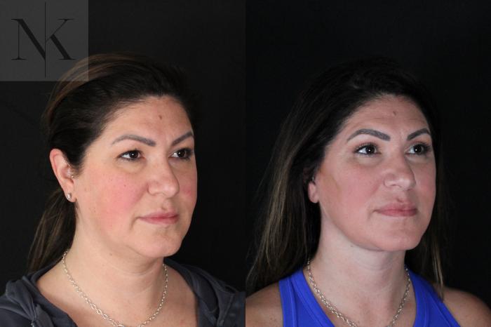 Before & After Deep Plane Facelift Case 199 Right Oblique View in Wethersfield, Hartford, Nebraska