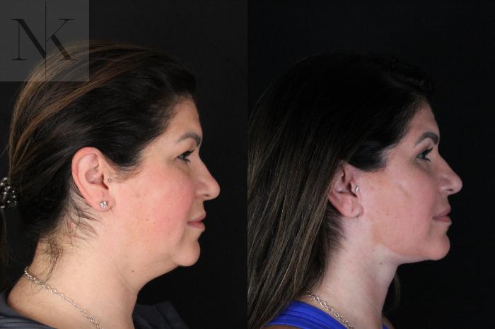 Before & After Deep Plane Facelift Case 199 Right Side View in Wethersfield, Hartford, Nebraska