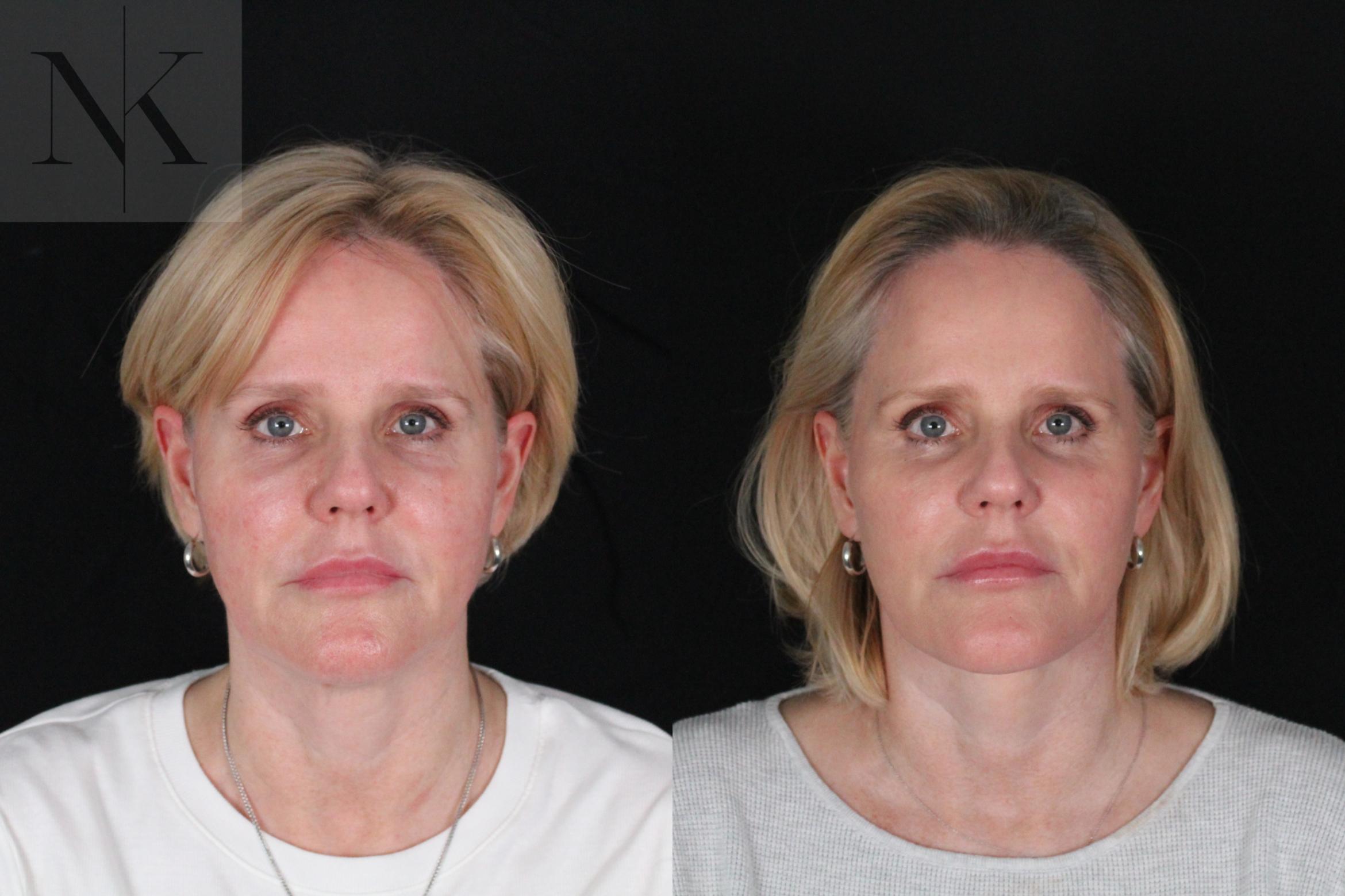 Before & After Deep Plane Facelift Case 203 Front View in Wethersfield, Hartford, Nebraska