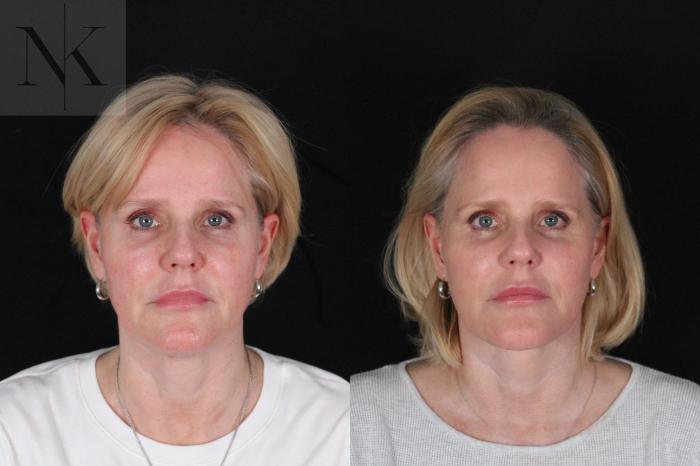 Before & After Deep Plane Facelift Case 203 Front View in Wethersfield, Hartford, Nebraska