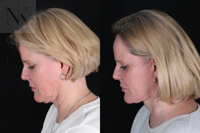 Before & After Deep Plane Facelift Case 203 Left Down View in Wethersfield, Hartford, Nebraska