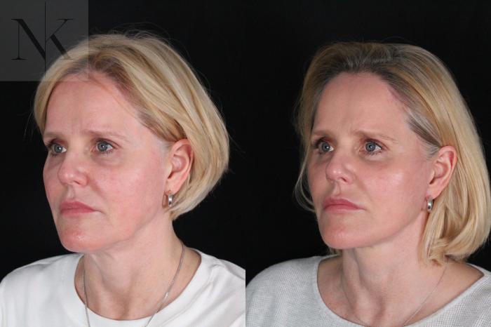 Before & After Deep Plane Facelift Case 203 Left Oblique View in Wethersfield, Hartford, Nebraska