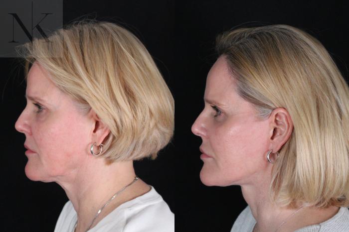 Before & After Deep Plane Facelift Case 203 Left Side View in Wethersfield, Hartford, Nebraska