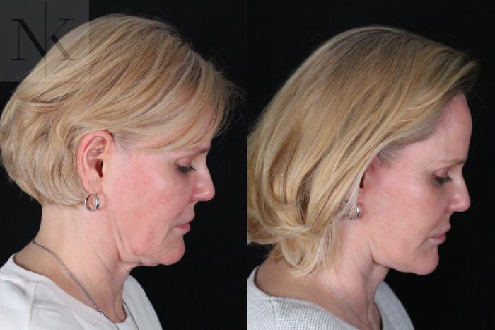 Before & After Deep Plane Facelift Case 203 Right Down View in Wethersfield, Hartford, Nebraska