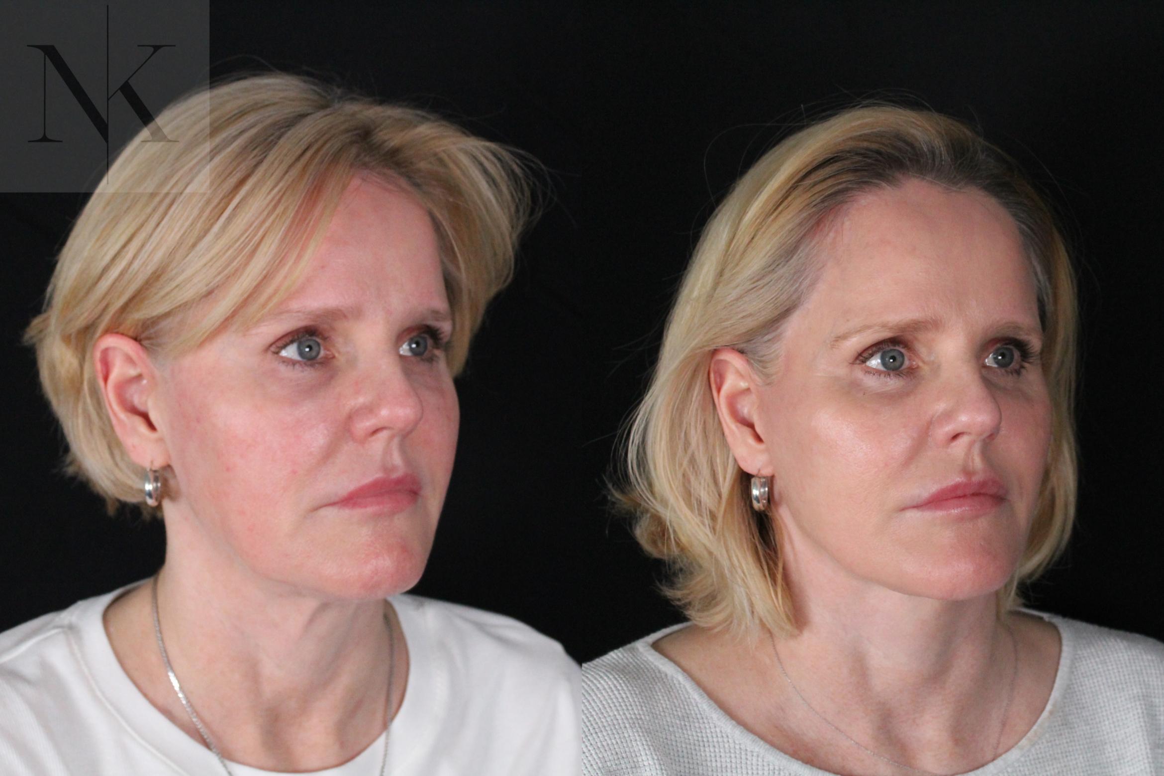 Before & After Deep Plane Facelift Case 203 Right Oblique View in Wethersfield, Hartford, Nebraska