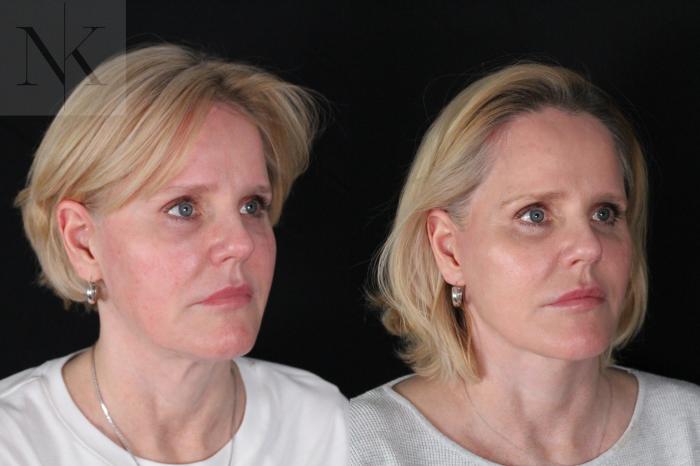 Before & After Deep Plane Facelift Case 203 Right Oblique View in Wethersfield, Hartford, Nebraska