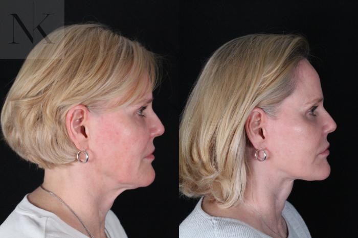 Before & After Deep Plane Facelift Case 203 Right Side View in Wethersfield, Hartford, Nebraska