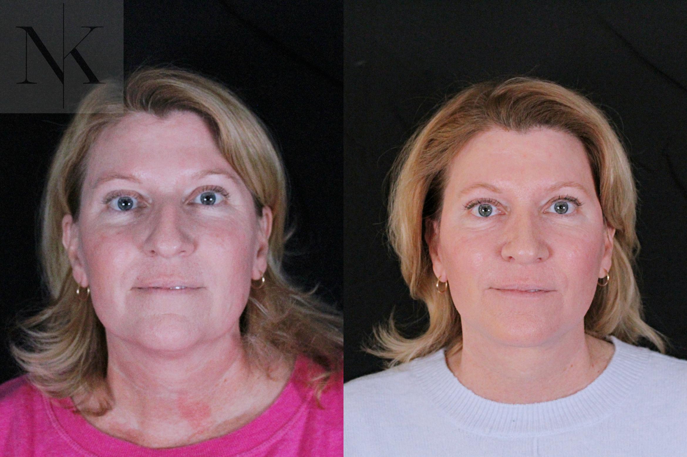 Before & After Deep Plane Facelift Case 208 Front View in Wethersfield, Hartford, Nebraska
