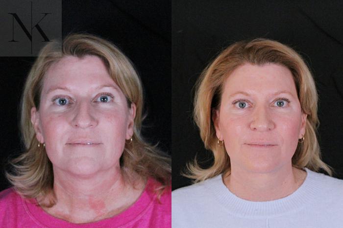 Before & After Deep Plane Facelift Case 208 Front View in Wethersfield, Hartford, Nebraska