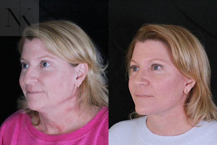Before & After Deep Plane Facelift Case 208 Left Oblique View in Wethersfield, Hartford, Nebraska