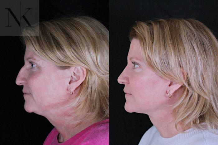 Before & After Deep Plane Facelift Case 208 Left Side View in Wethersfield, Hartford, Nebraska