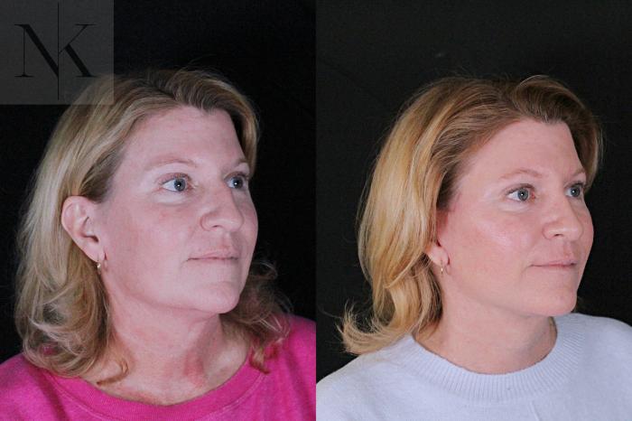 Before & After Deep Plane Facelift Case 208 Right Oblique View in Wethersfield, Hartford, Nebraska