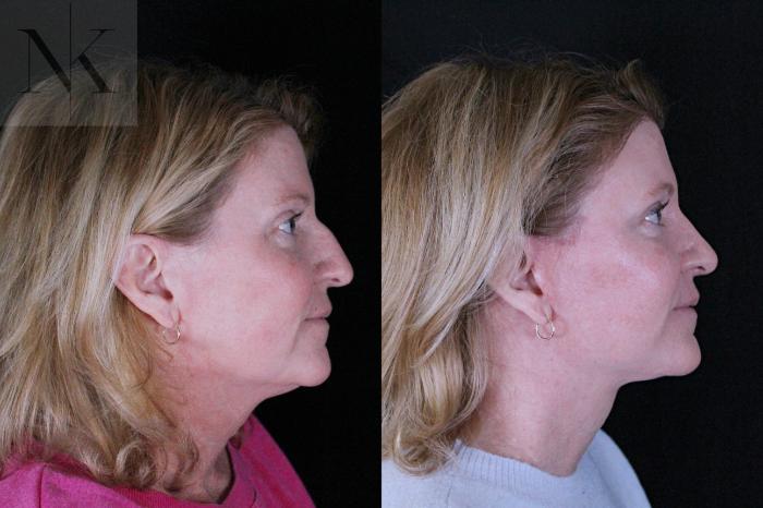 Before & After Deep Plane Facelift Case 208 Right Side View in Wethersfield, Hartford, Nebraska