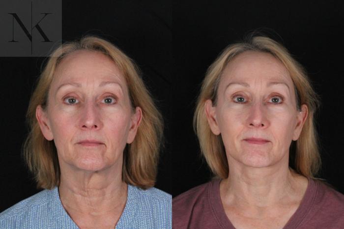 Before & After Deep Plane Facelift Case 211 Front View in Wethersfield, Hartford, Nebraska