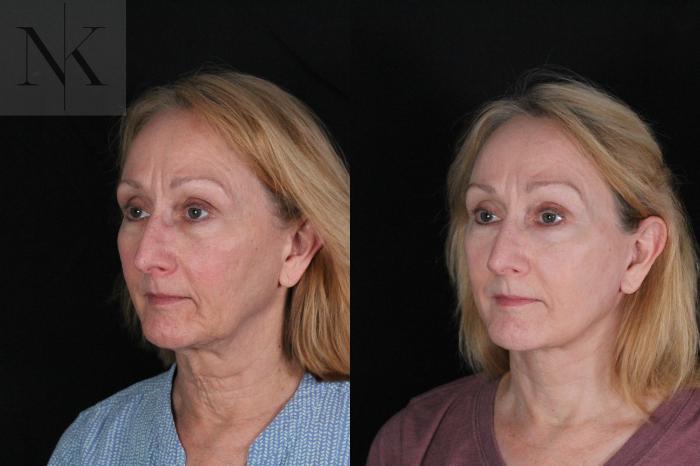 Before & After Deep Plane Facelift Case 211 Left Oblique View in Wethersfield, Hartford, Nebraska