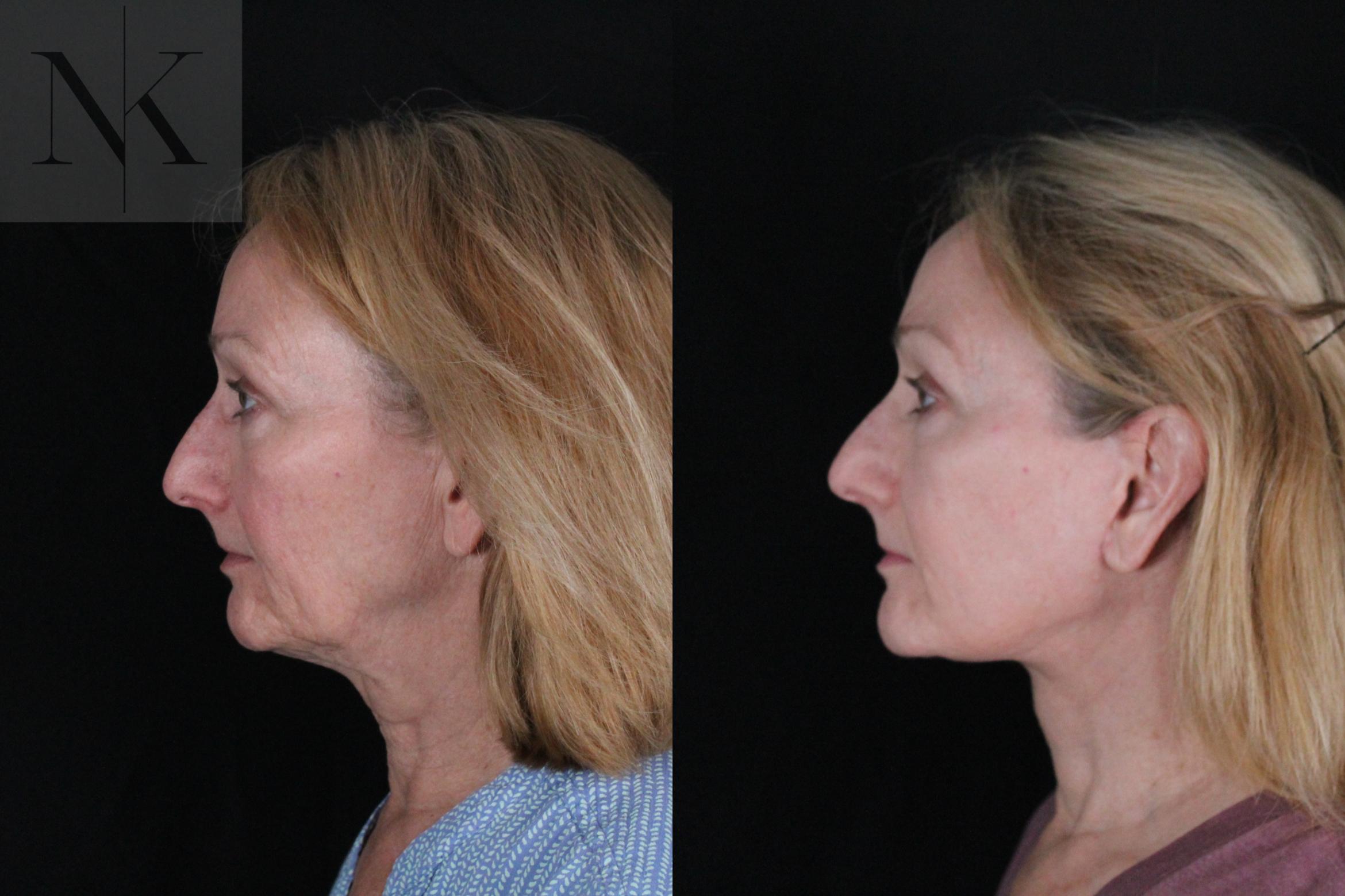 Before & After Deep Plane Facelift Case 211 Left Side View in Wethersfield, Hartford, Nebraska