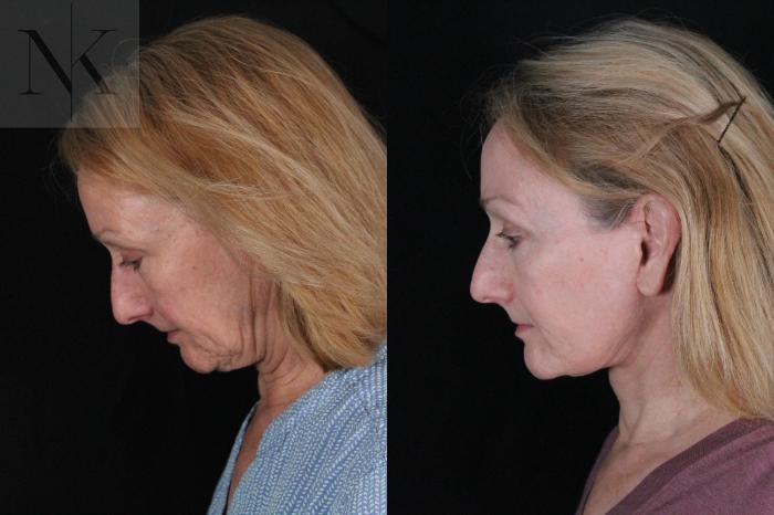 Before & After Deep Plane Facelift Case 211 Left Side Down View in Wethersfield, Hartford, Nebraska