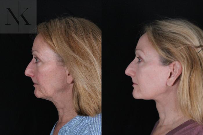 Before & After Deep Plane Facelift Case 211 Left Side View in Wethersfield, Hartford, Nebraska