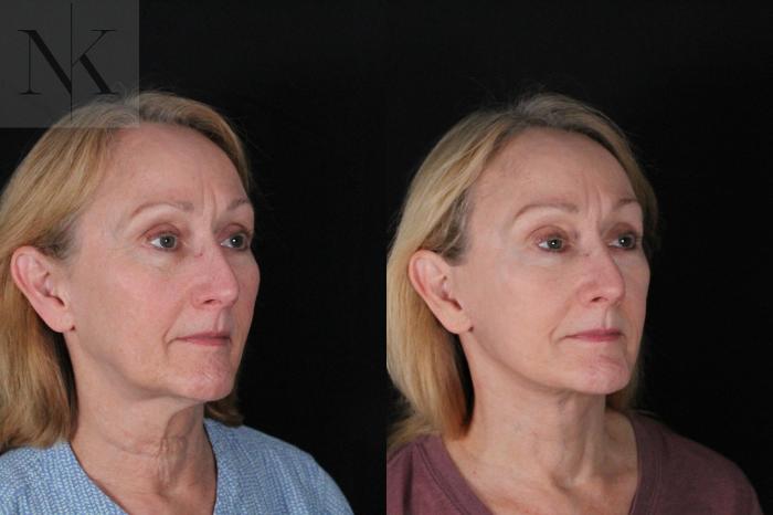 Before & After Deep Plane Facelift Case 211 Right Oblique View in Wethersfield, Hartford, Nebraska