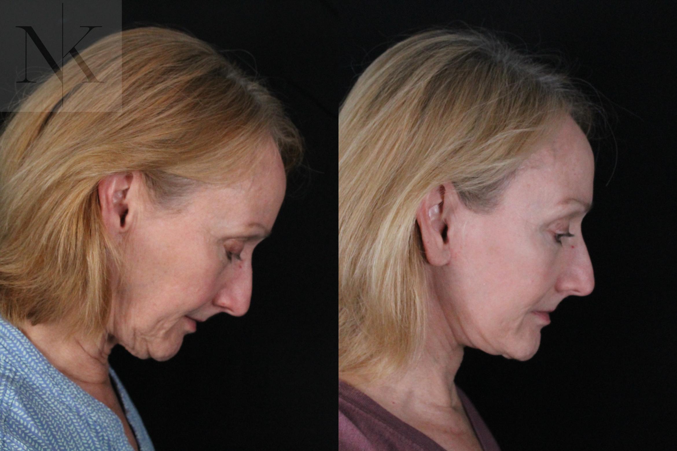 Before & After Deep Plane Facelift Case 211 Right Side Down View in Wethersfield, Hartford, Nebraska