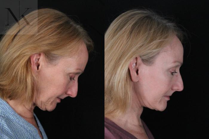 Before & After Deep Plane Facelift Case 211 Right Side Down View in Wethersfield, Hartford, Nebraska