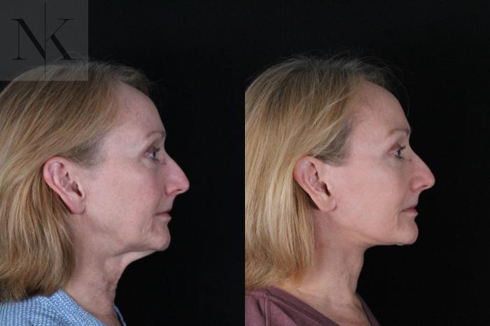 Before & After Deep Plane Facelift Case 211 Right Side View in Wethersfield, Hartford, Nebraska