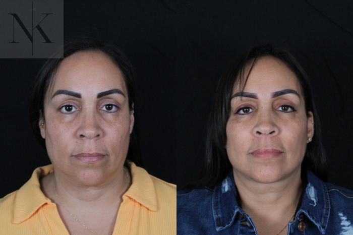 Before & After Deep Plane Facelift Case 212 Front View in Wethersfield, Hartford, Nebraska