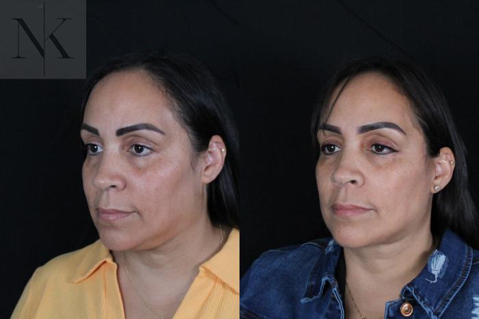 Before & After Deep Plane Facelift Case 212 Left Oblique View in Wethersfield, Hartford, Nebraska